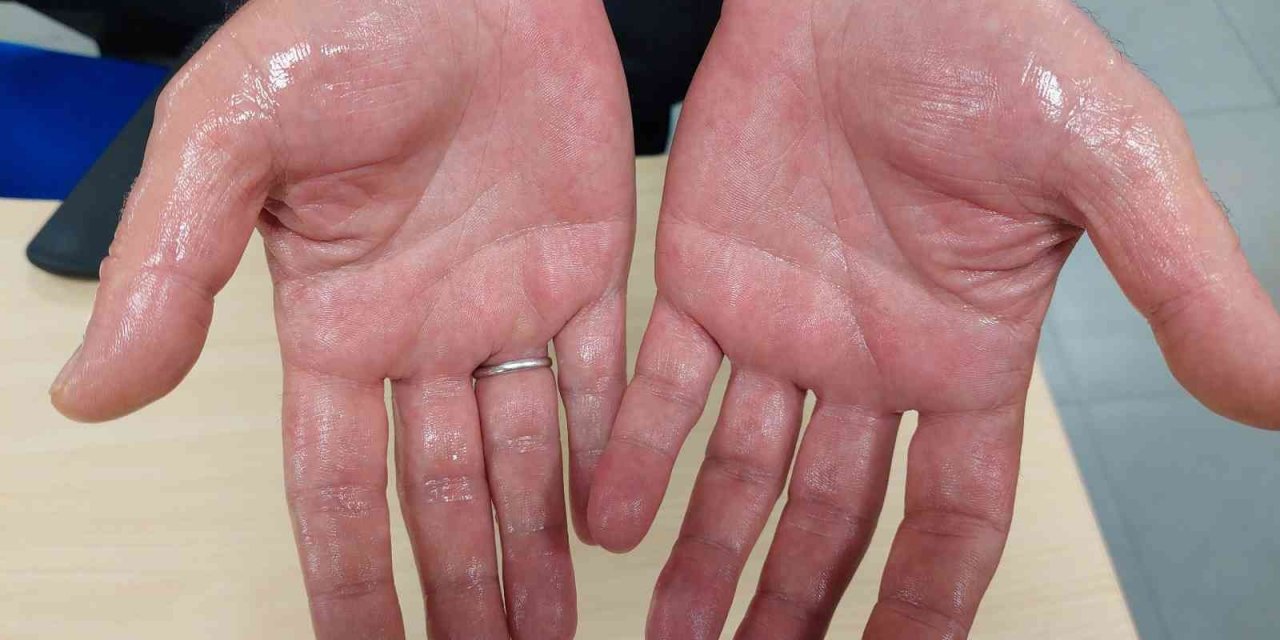 Uzmanından aşırı terleme tavsiyesi: Ertelemeyin