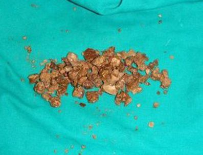 Böbrek taşını önleyin