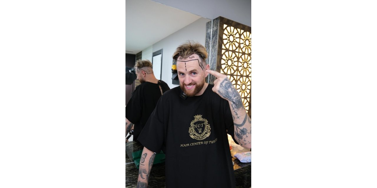 İngiliz Youtuber Kristen Hanby, Türkiye’de saç ektirdi