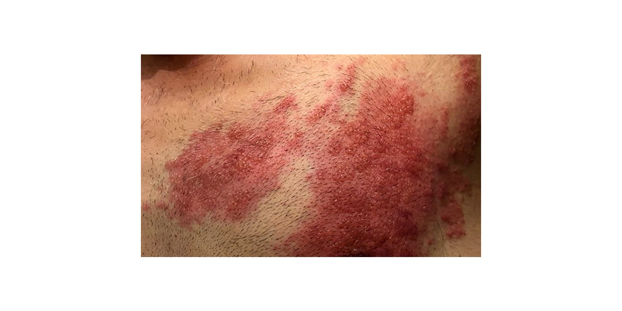 Zayıflayan bağışıklık zona vakalarını artırdı