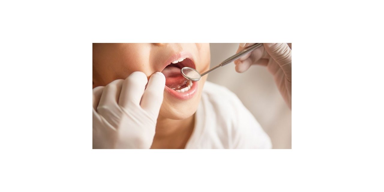 Flor diş çürüklerini yüzde 20 ile 40 arasında engelliyor