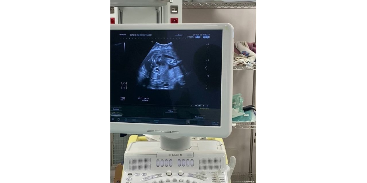 Anne karnındaki bebeğe stent takıldı