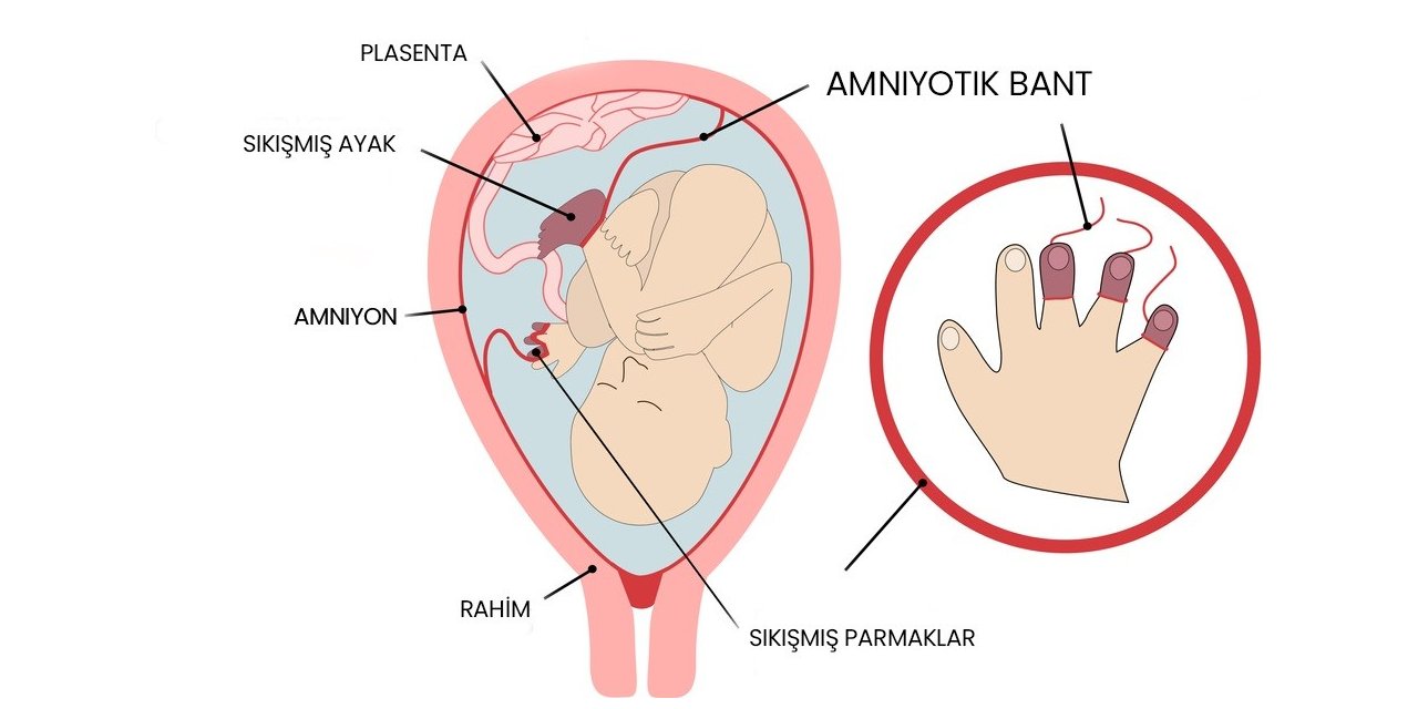 Amniyotik bant sendromu olan bebekler anne karnında ameliyat ile tedavi edilebiliyor