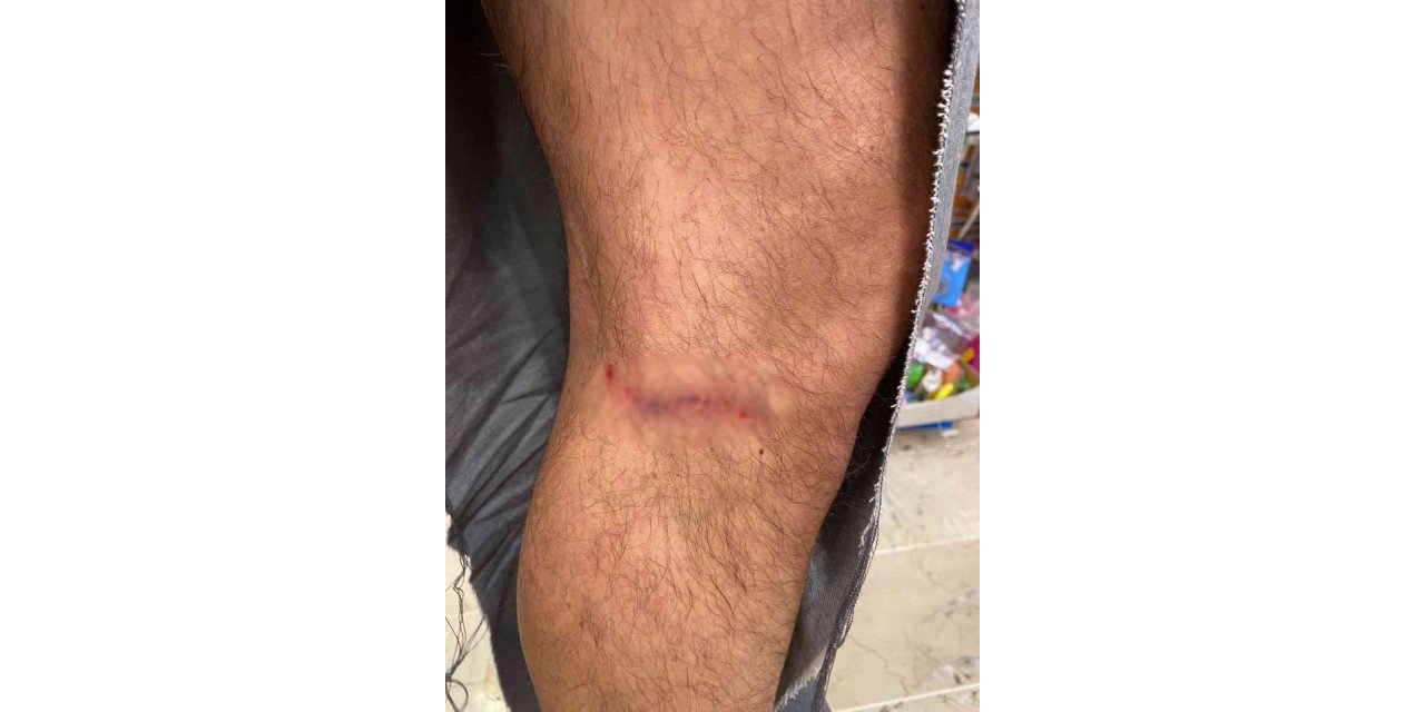 Çankaya’da başıboş köpekler vatandaşın kıyafetlerini parçaladı