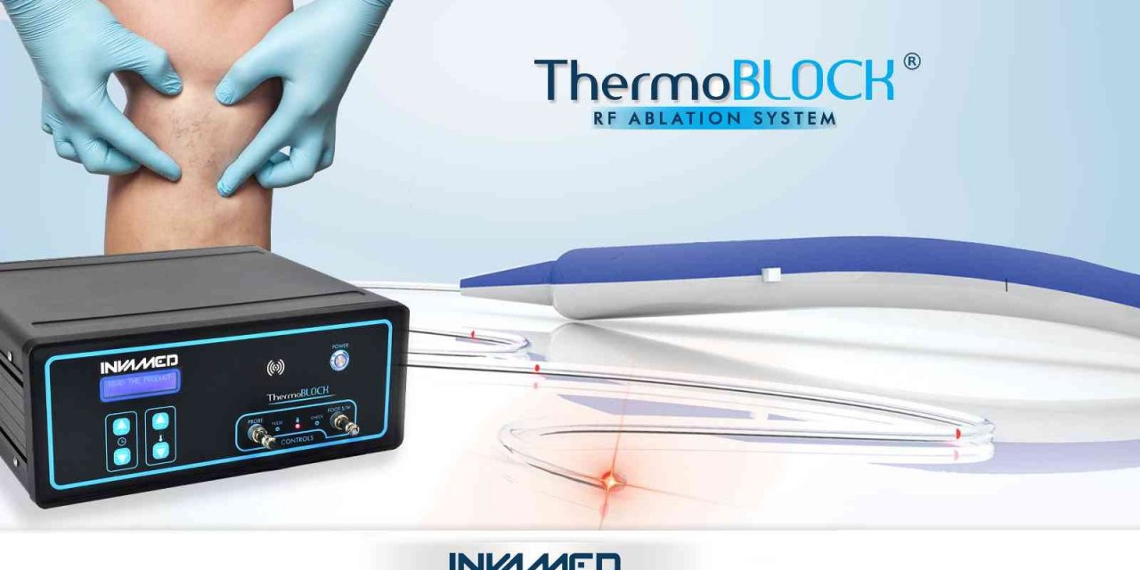 Radyofrekans yöntemiyle kılcal damarlarda acısız ve ağrısız tedavi imkanı