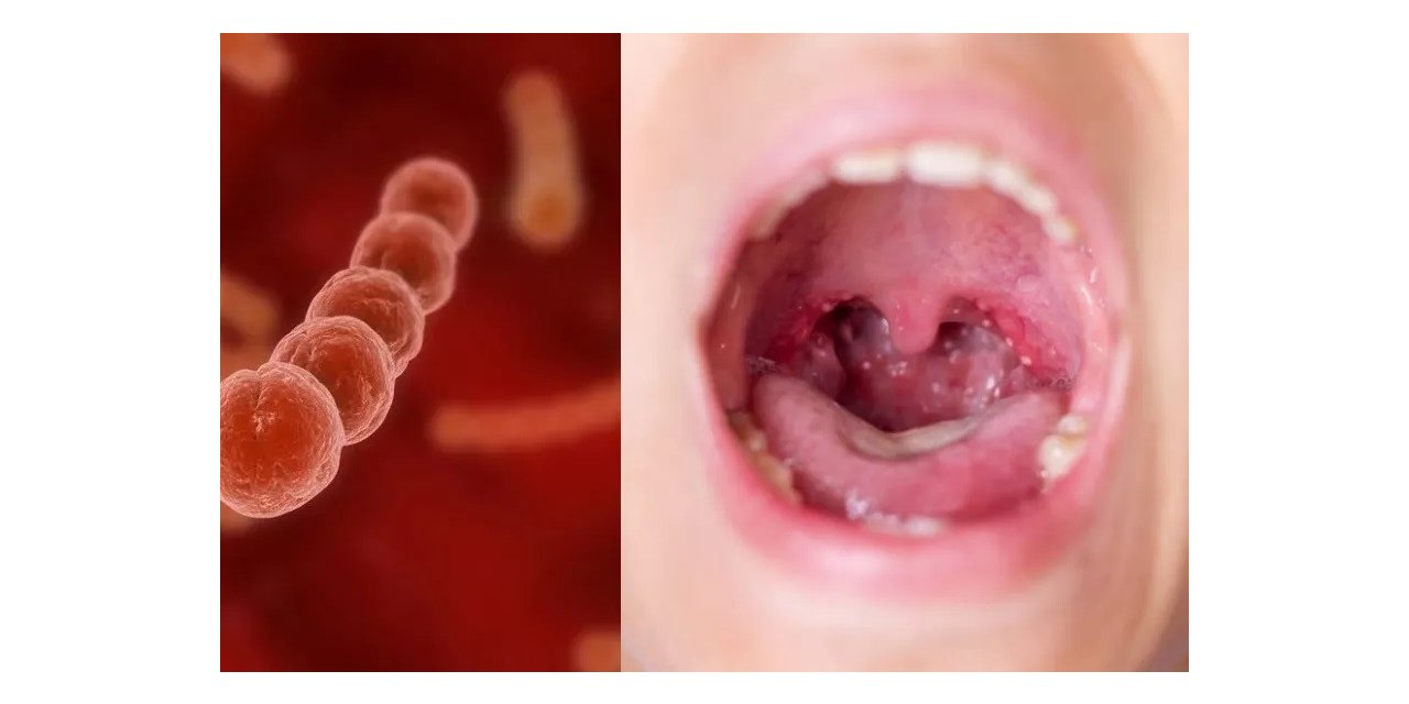 İşgalci şekle bürünen “Streptokok A” bakterisinde ölüm riski