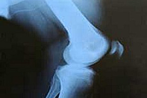 Dikkat! Kemik erimesine neden oluyor