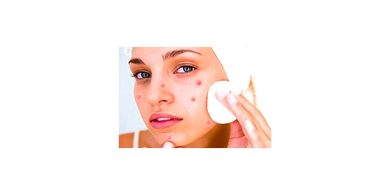 Doç. Dr. Pelin Üstüner, “Skara dönüşen aknenin tedavisi yok”