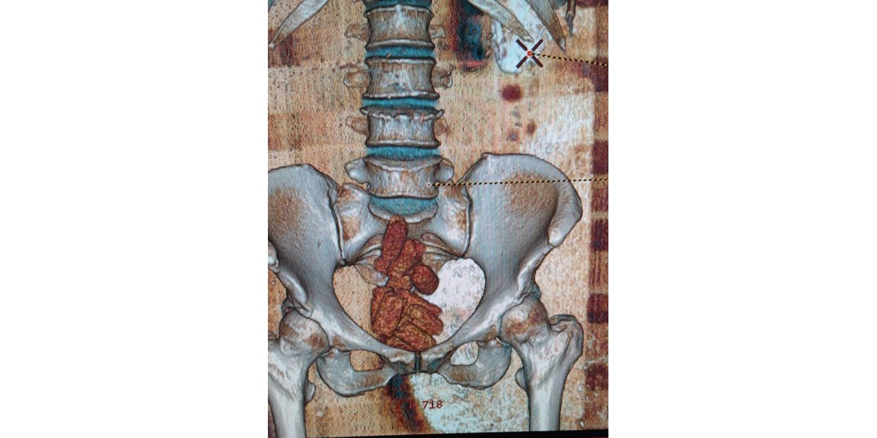 Uyuşturucu maddeyi bağırsaklarında saklamışlar