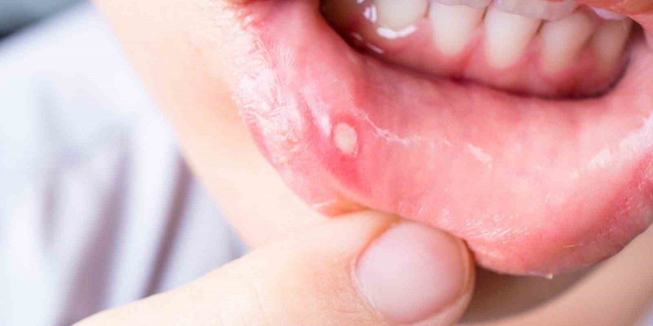 Sık kullanılan ağız gargaraları bu hastalığa sebep olabilir