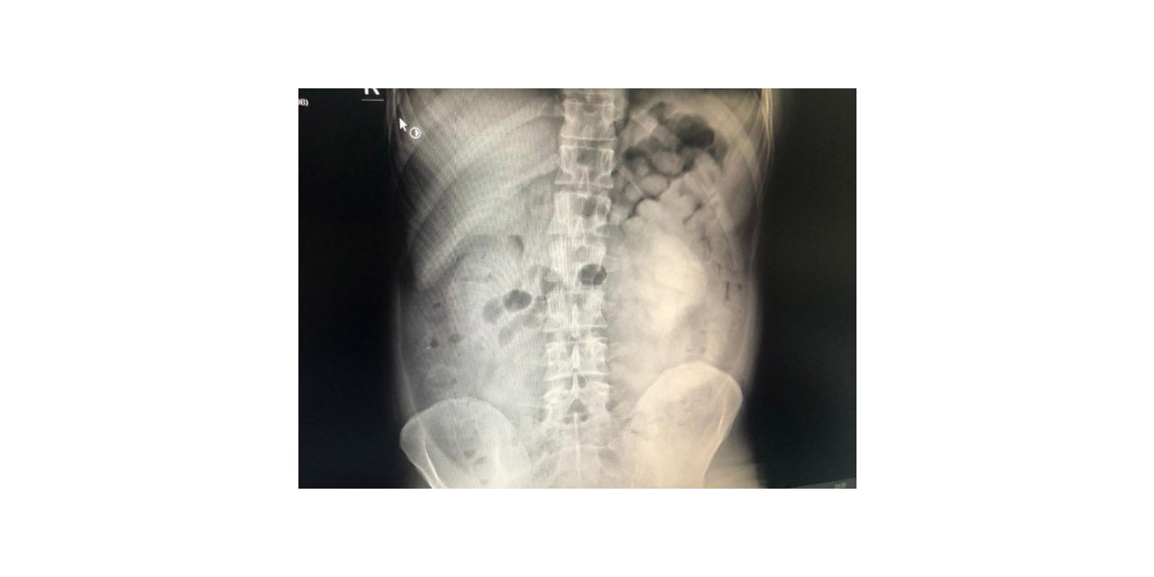 Diyarbakır’da şüpheli yolcunun midesinden 800 gram eroin çıktı