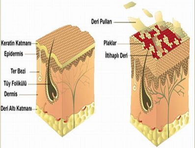 Sedef hastaları dışlanıyor