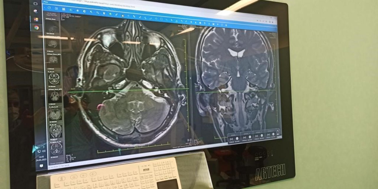 Eskişehir Şehir Hastanesinde ilk yüz felci ameliyatı gerçekleştirildi