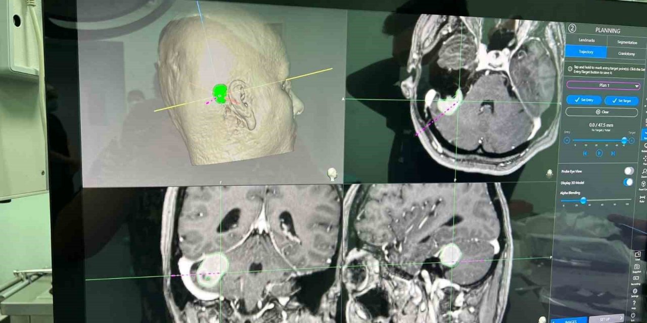 Niğde’de ilk köşe tümörü ameliyatı başarıyla gerçekleştirildi