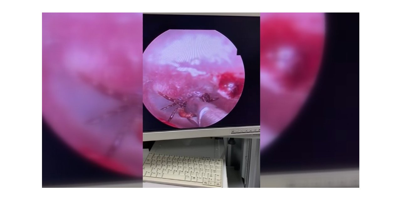 Kulak ağrısıyla hastaneye gitti, kulağından kene çıktı