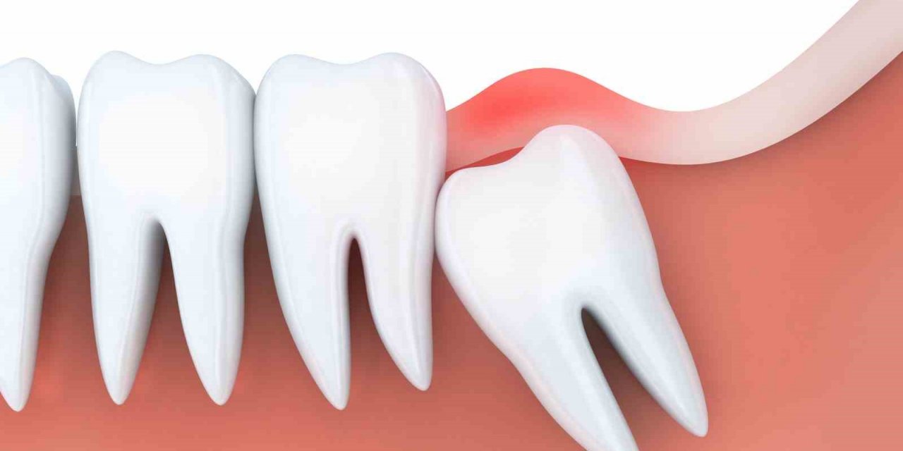 “Bütün gömülü dişlerin çekilmesi gerekmiyor”