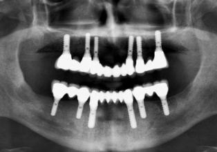 Takma diş protezlere elveda