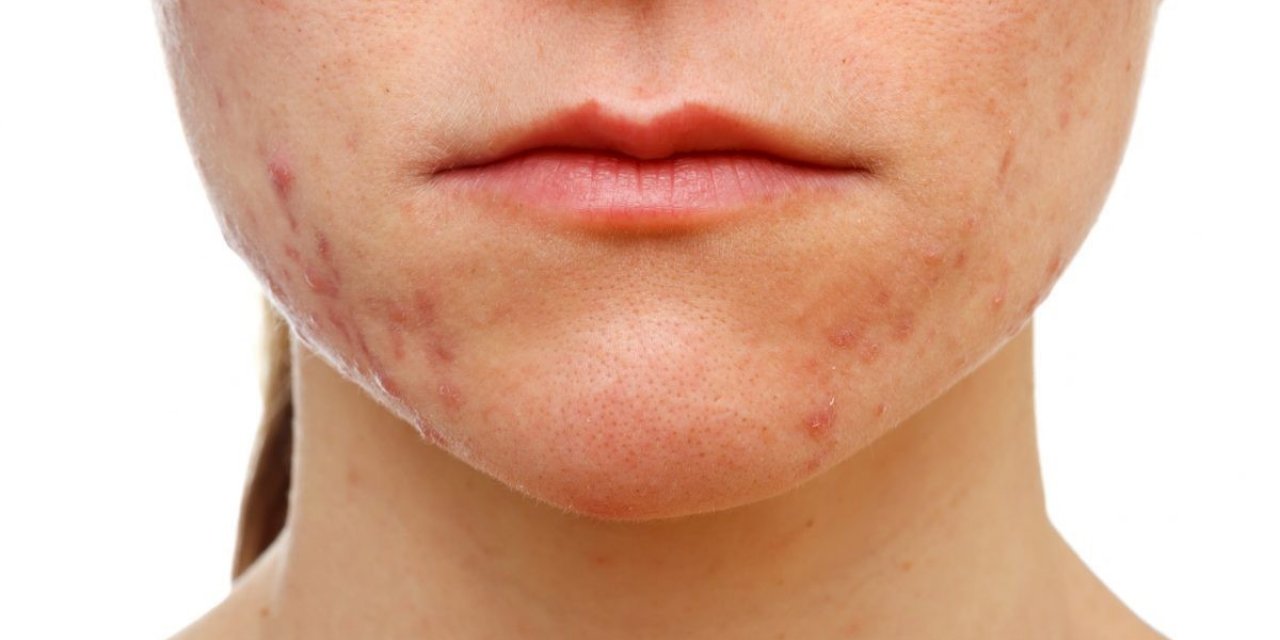 2030 yılında toplumun yüzde 50’si alerjik hasta olabilir