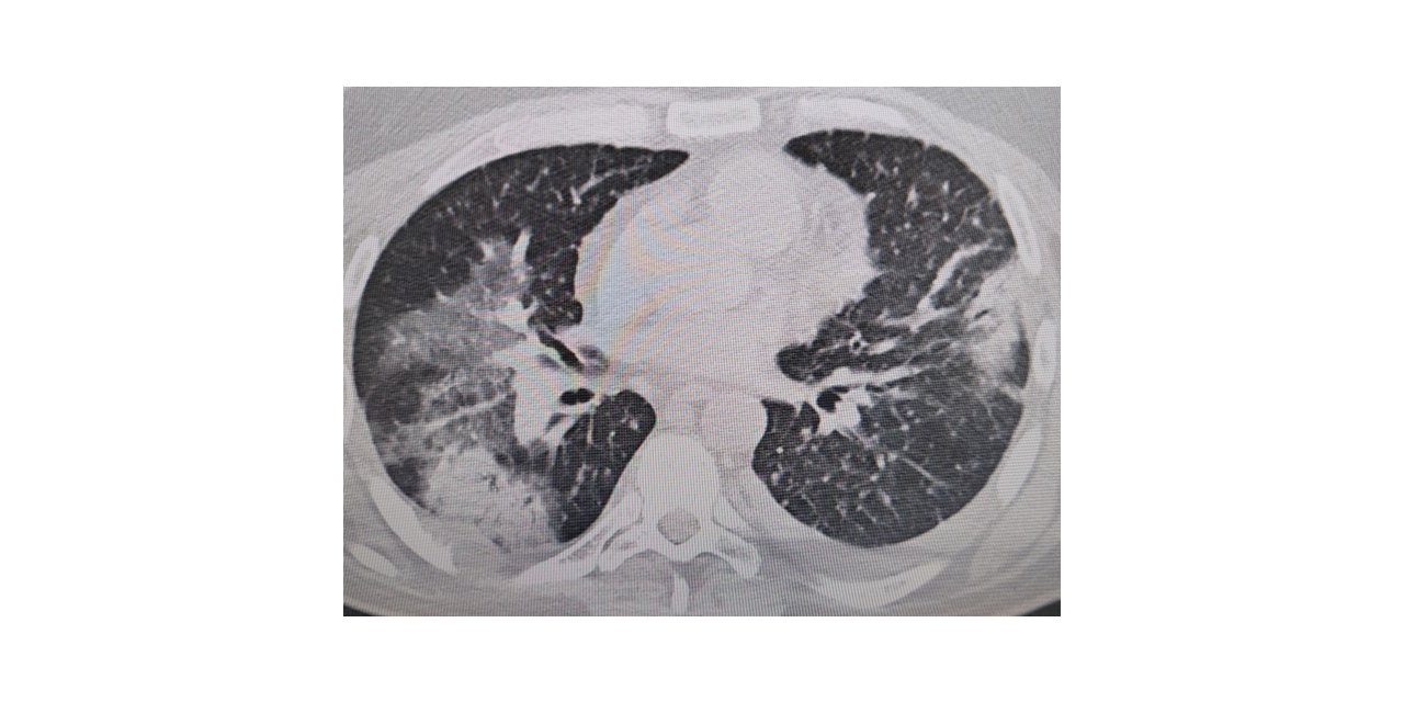 Klimaya bağlı “yaz zatürresine” dikkat