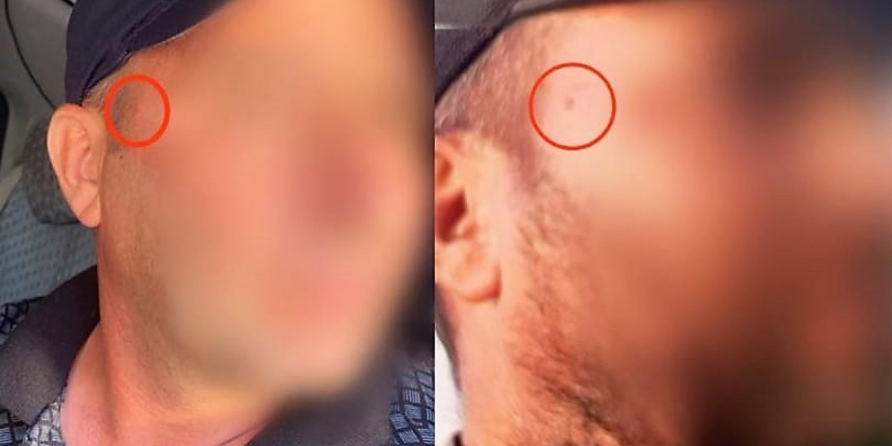 Jandarma korkusundan yüzündeki beni aldırdı