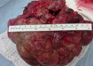 Midesinden 5 kilo tümör çıkarıldı