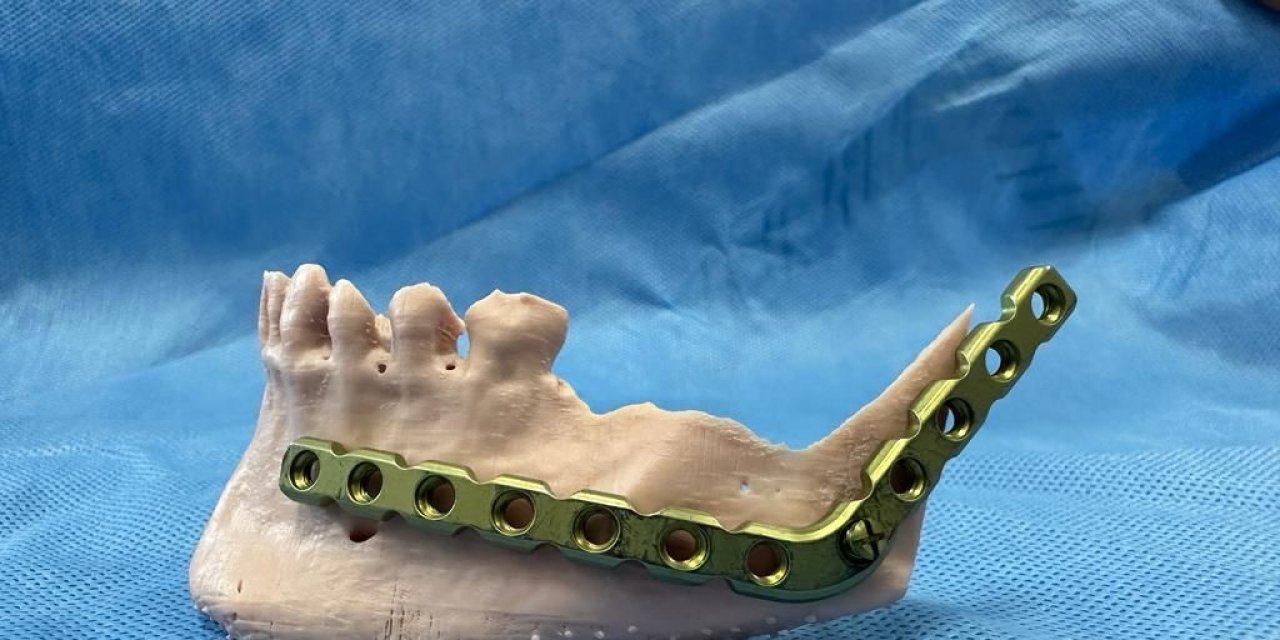 3D modelleme üzerinde test yapıldı, ardından hastaya uygulandı