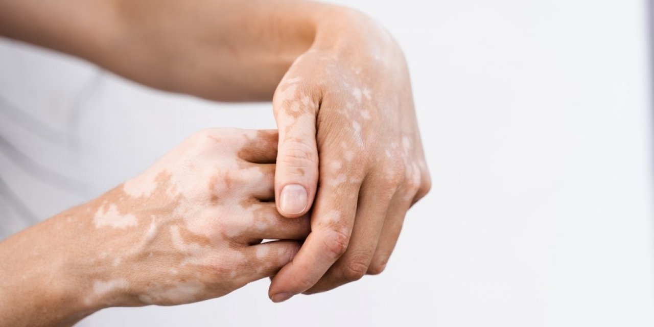 Leke tedavisinde en önemli adım güneşten korunmak