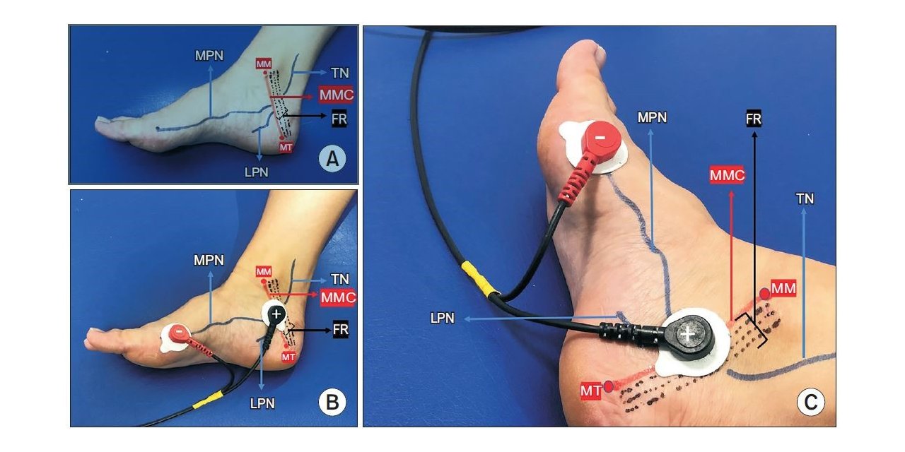İdrar kaçırmada PAÜ Tıp Fakültesi’nden dünyada ilk