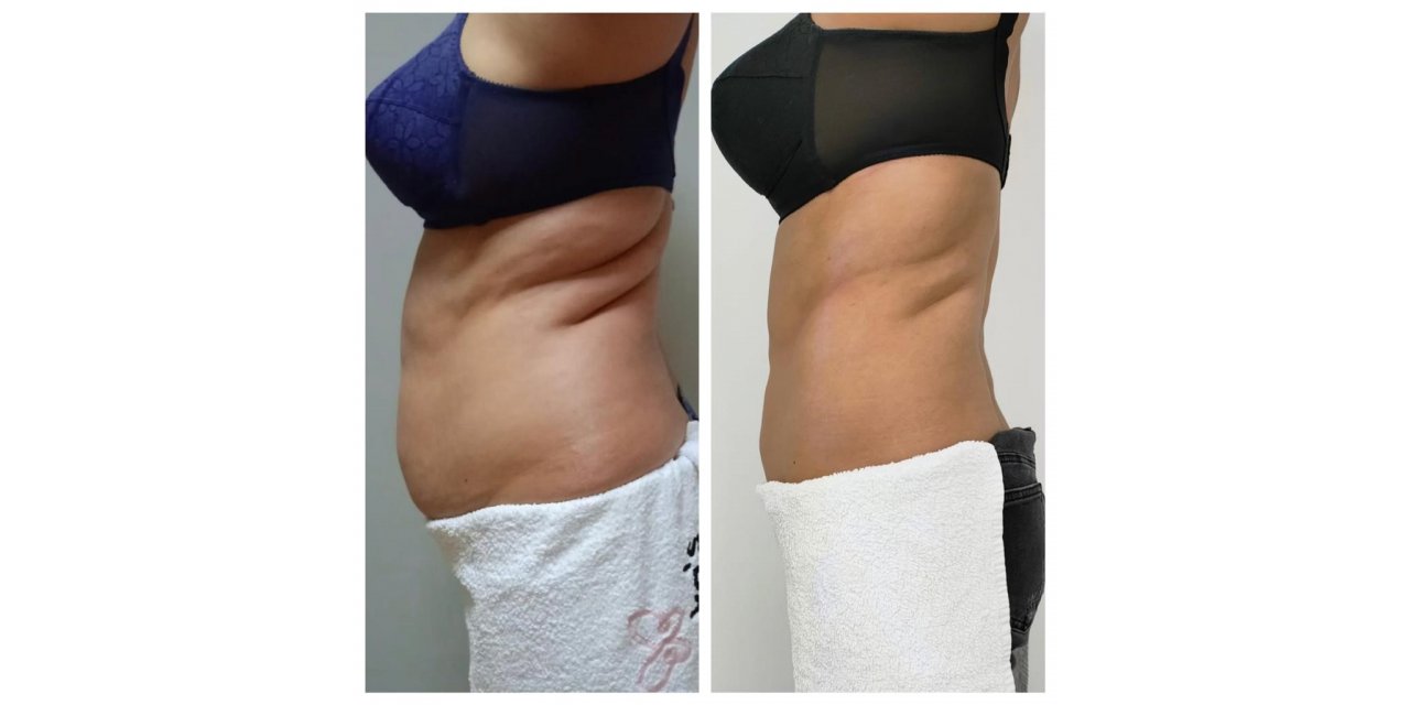 Tek seansta 3.5 santim incelme mümkün