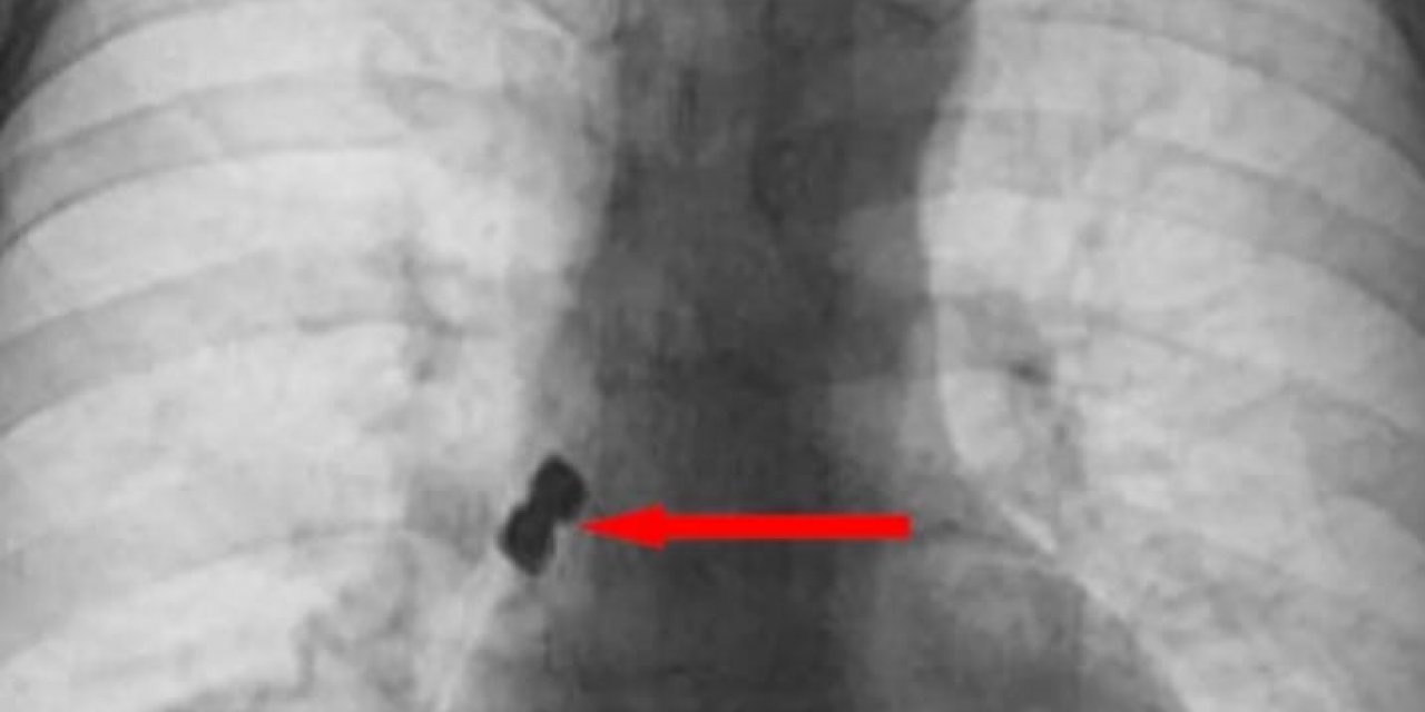 Diş tedavisinde hastanın başına geleni duyanlar şaştı kaldı