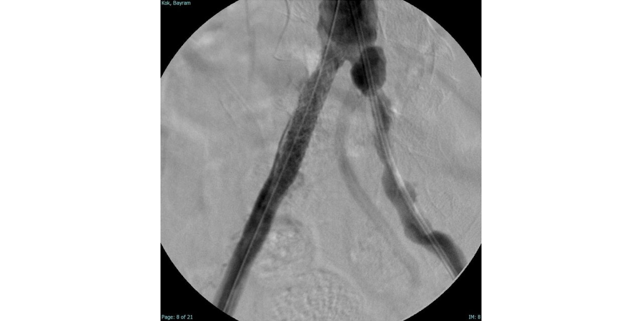 Türkiye’nin ilk yerli stent grefti başarıyla hastalara uygulandı