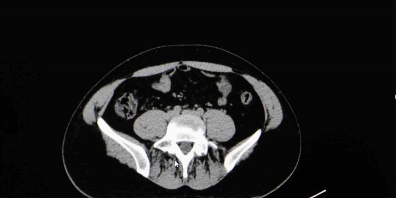 Uzmanından yaz aylarında çok görülen sistit uyarısı