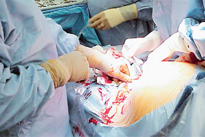 3 yılda 1 milyon 858 bin kadına sezaryen