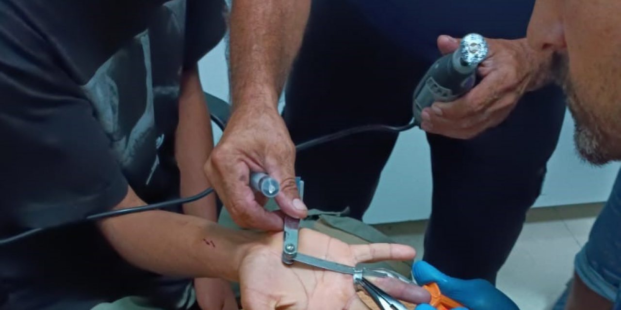 Parmağa sıkışan yüzük kesilerek çıkarıldı