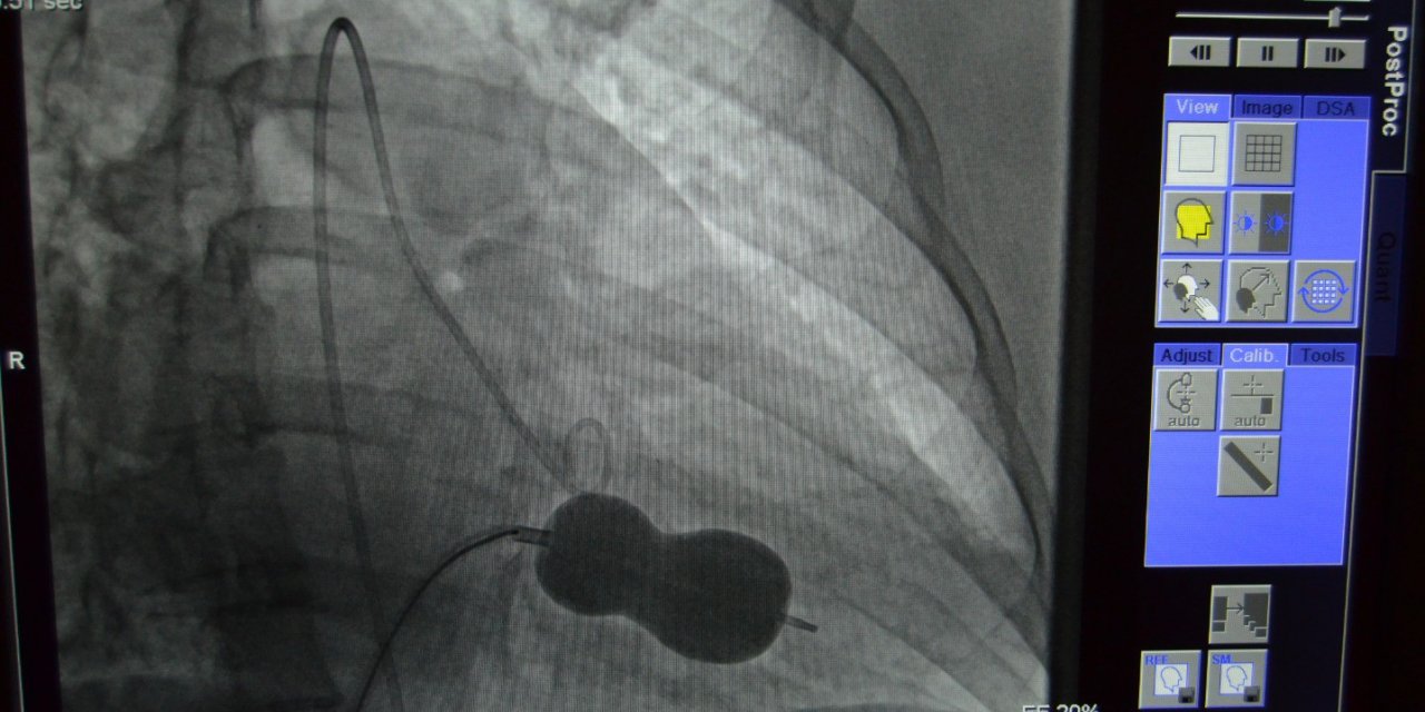 Alanya’da mitral kapak darlığı ameliyatsız tedavi edildi