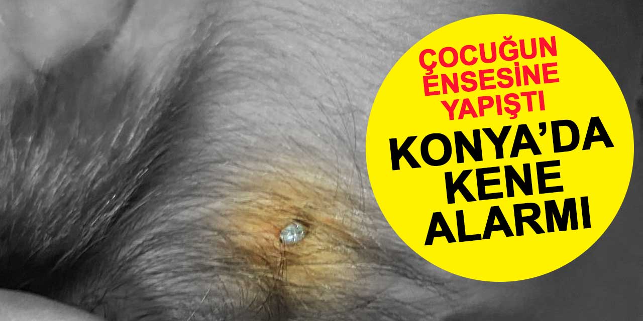 Konya'da kene alarmı! 4 yaşındaki çocuğun ensesine yapıştı