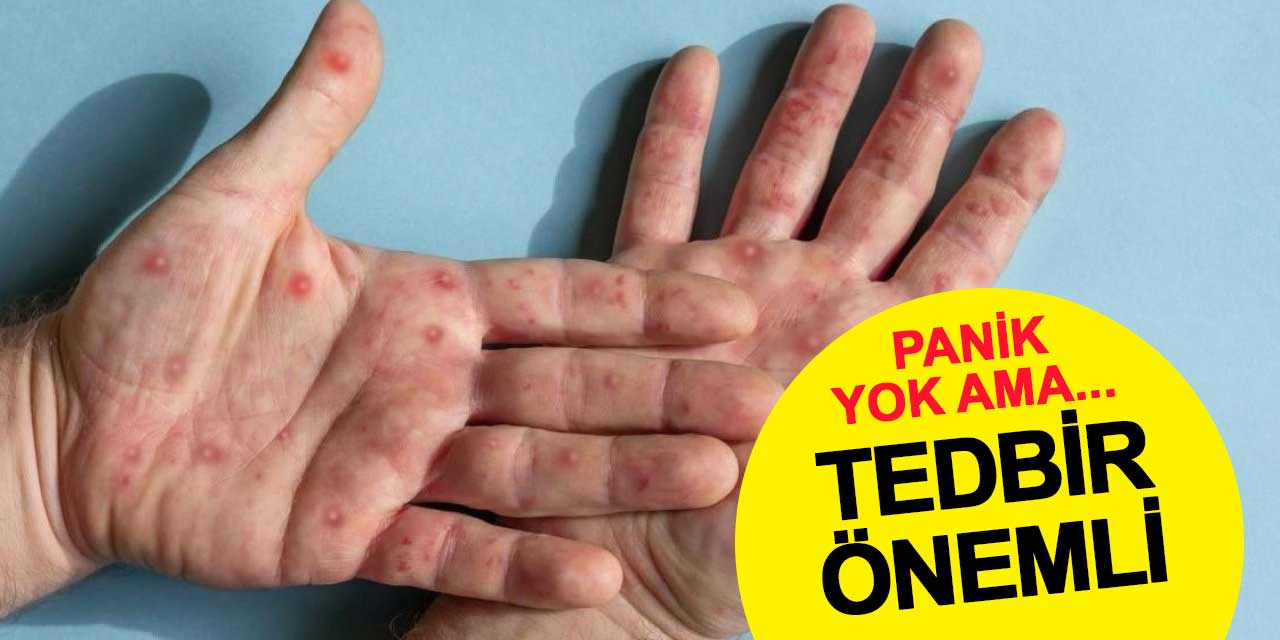 Türkiye’de M-Virüsü Paniği Gerektirmiyor Ama Tedbirler Önemli