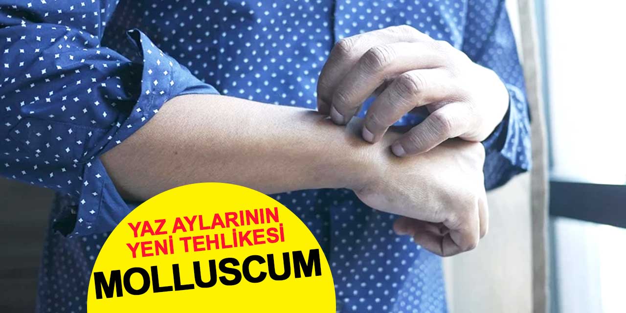 Yaz aylarının yeni tehlikesi: Molluscum
