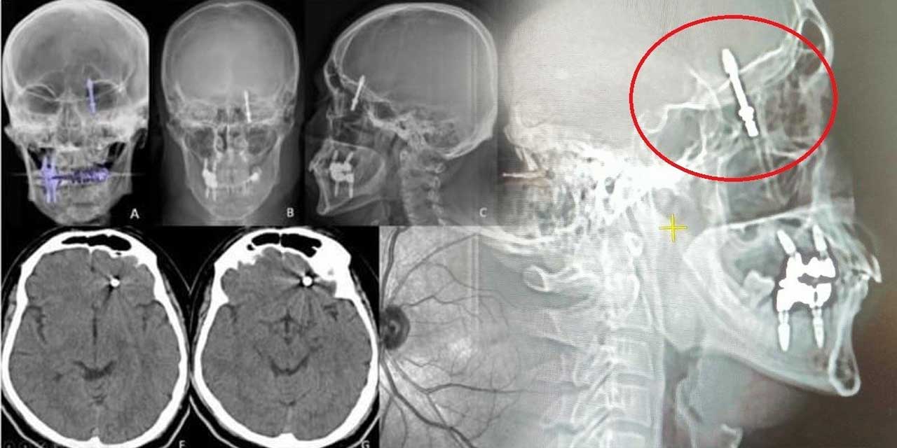 İmplant vidası kafatasına saplandı, ölümün kıyısından döndü
