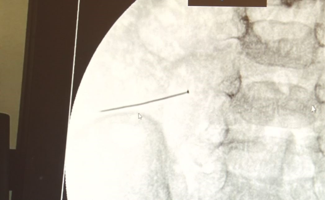 Ağrıdan kıvranan 2 yaşındaki çocuğun karnından çıktı