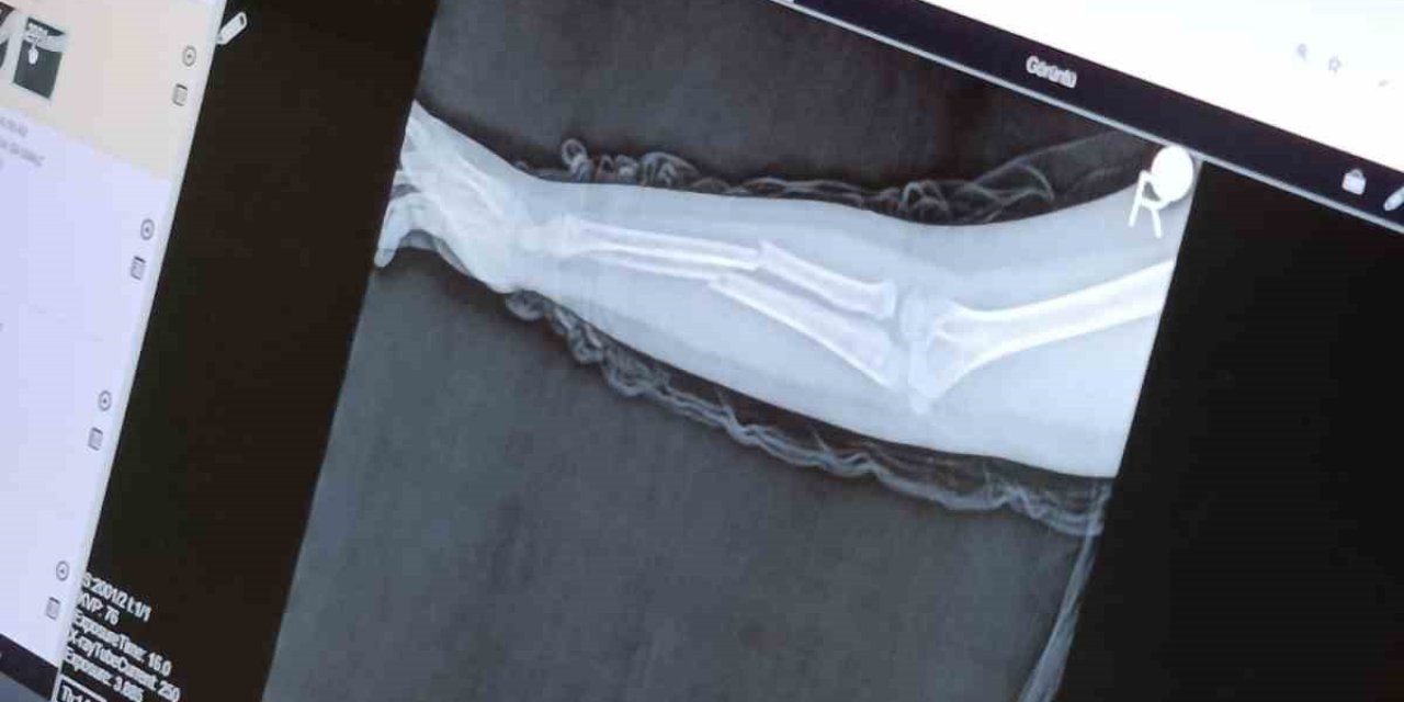 Yine akran zorbalığı: 8 yaşındaki çocuğun kolu 2 yerinden kırıldı