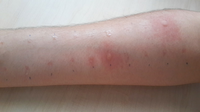 Bahar Geldi, Kurdeşen Arttı: Uzmanlardan Hayati Uyarılar