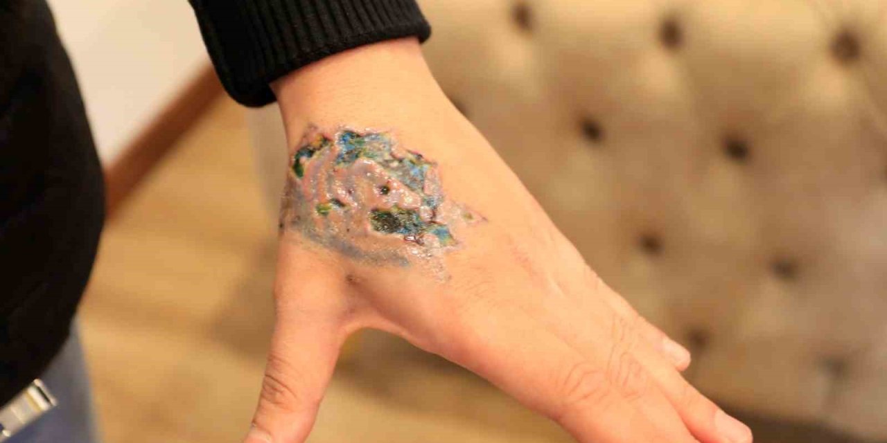 Dövme Silme Seansı Sonrası Hastanelik Oldu! Deri Nakli Olabilir