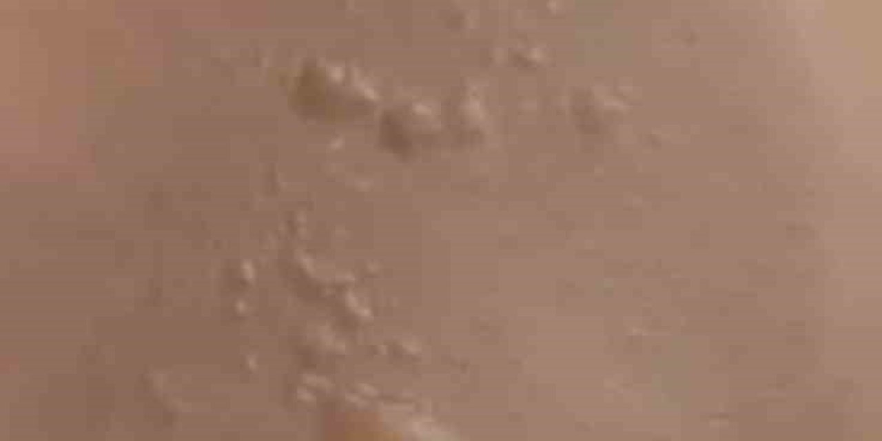 Sıcak su torbası yine yaktı