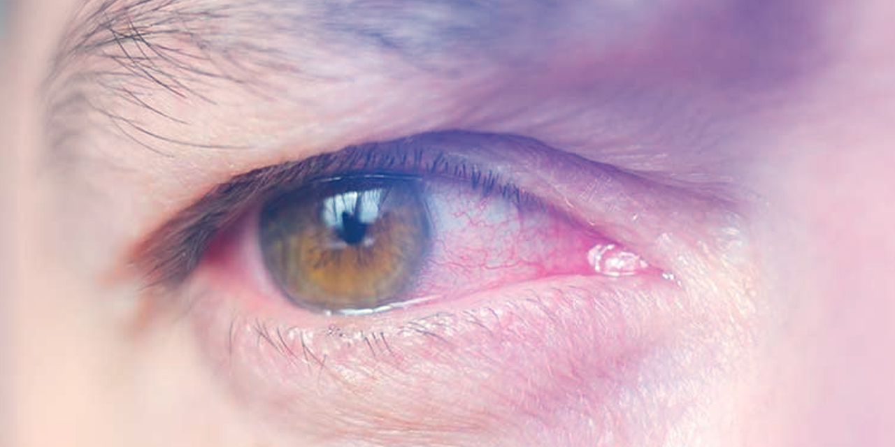 Gözün "Sessiz Hırsızı" Glokom: Erken Teşhis Hayat Kurtarıyor