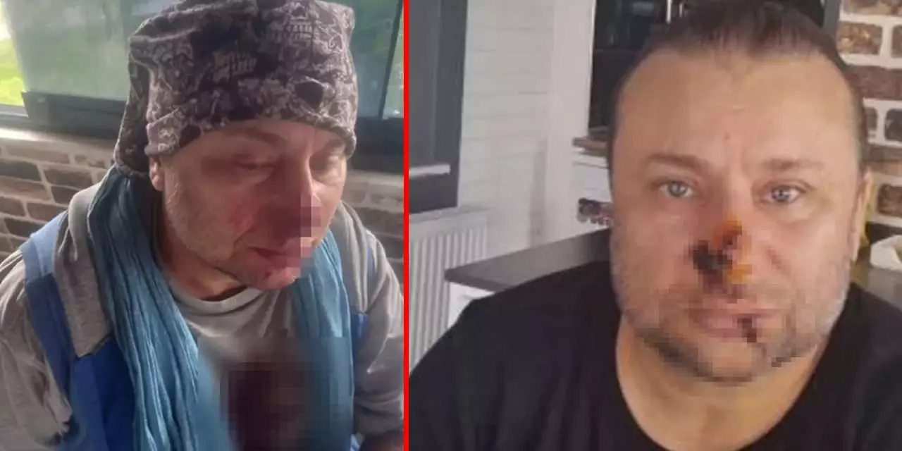 Onur Akay Pitbull Saldırısı Sonrası Hastaneye Kaldırıldı