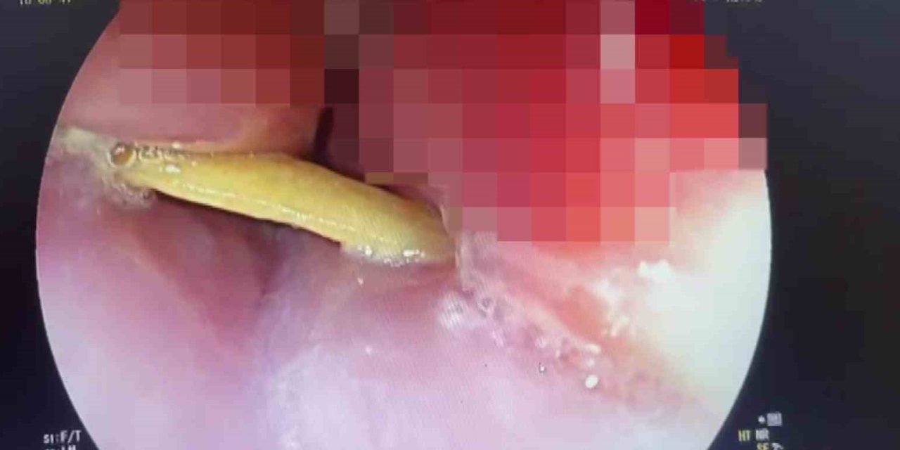 Yediği etin kemiği boğazına saplandı