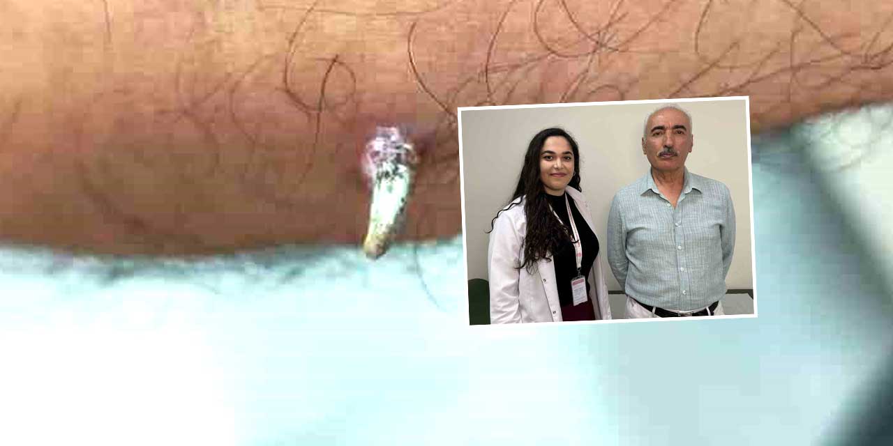 Dirseğindeki Yara Cilt Kanseri Çıktı: Erken Teşhis Hayat Kurtardı