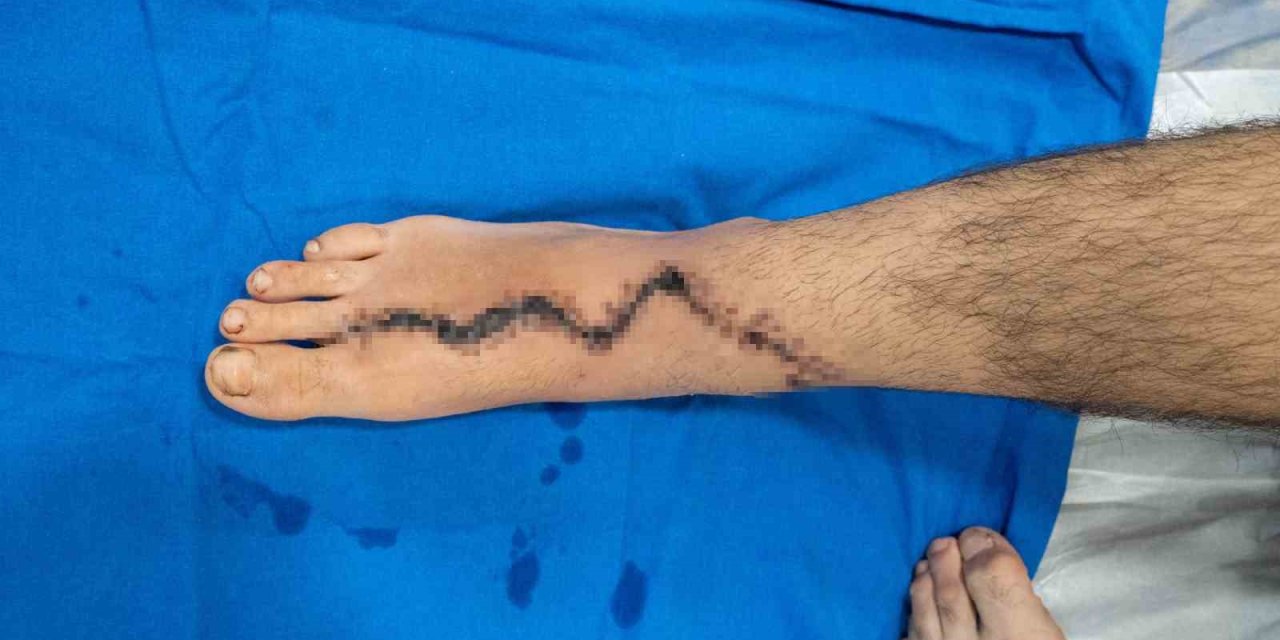 10 Saatlik Ameliyatla Ayağından Eline Parmak Nakledildi