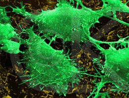 15 dakikalık tedaviyle kanserden kurtuldu